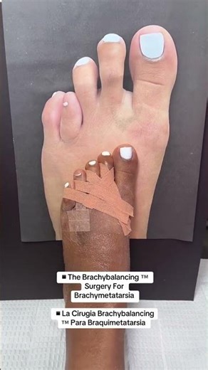 JUST WOW!🙌🏼#brachymetatarsia #brachymetatarsiasurgery #braquimetatarsia