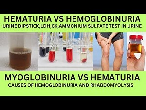 HOW TO DIFFERNTIATE HEMATURIA VS HEMOGLOBINURIA VS MYOGLOBINURIA.CAUSES ,URINE DIPSTICK,LDH AND CK