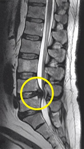 Lumbar Spinal Stenosis Recovery — Without #Surgery #stenosis