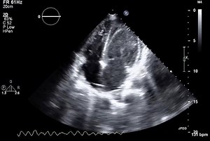 A 50-year-old woman with a history of cardiac transplantation had acute cellular rejection of the transplanted heart. Transthoracic echocardiography, shown in a video, was performed while she was receiving venoarterial extracorporeal membrane oxygenation and revealed ventricular fibrillation with preserved atrial contractility, consistent with atrioventricular dissociation. https://nej.md/2ZKH4f4 | The New England Journal of Medicine