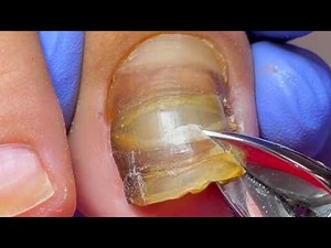 Cut Off Any Deteriorated, Split Toenails Completely!【Xue Yidao】