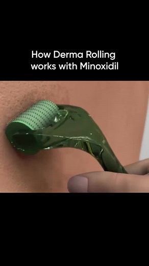 HairCode AI on Instagram: "How dermaroller works with minoxidil  #minoxidilresult #hairregrowth #hairprogress #dermaroller #dermarollertips"