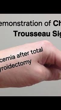 𝗖𝗵𝘃𝗼𝘀𝘁𝗲𝗸 & 𝗧𝗿𝗼𝘂𝘀𝘀𝗲𝗮𝘂 𝗦𝗶𝗴𝗻𝘀 | Total thyroidectomy | Hypocalcemia ‪@Tayyabriazch‬