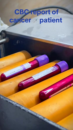 Complete Blood Count (CBC) Test Explained for Cancer Patients