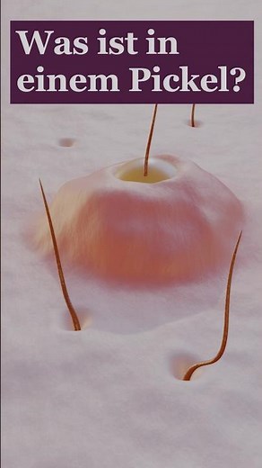 Pus in a pimple | What does the secretion consist of?