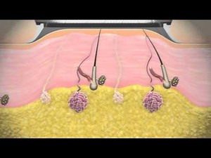 miraDry Me How underarm sweat treatment works