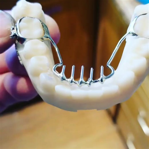 38K views · 135 reactions | Spikey for tongue thrusting #Dentistry #LearningTips #BitesnBraces #smile #medical #People #dentista #Tooth #Implant #Dental #dentist | Bites & Braces Dental | Facebook