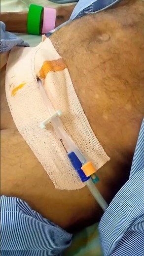 Suprapubic Catheter 💉 ICU 🏥