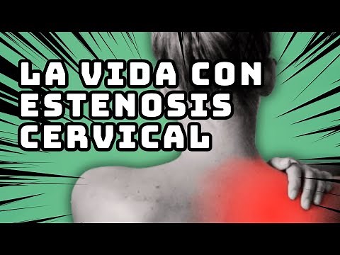 What is cervical stenosis? Symptoms, causes, and risks