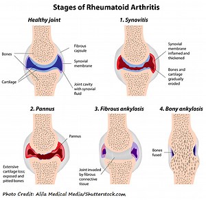 Rheumatoid Arthritis NCLEX Review