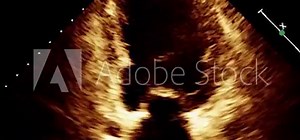 Transesophageal Ultrasound Echocardiography.