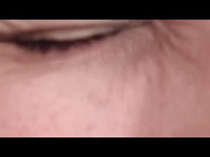 left eye fasciculation