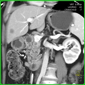 main duct IPMN | CTisus: Cutting edge information on body CT (Computed tomography).