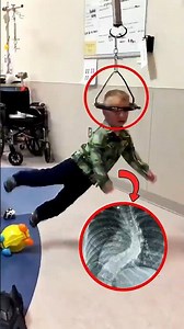 The Secret Behind the Metal Ring Around Scoliosis Patients' Heads😇