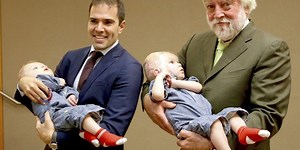 Twins born with conjoined heads appear separated after successful operation (Video)