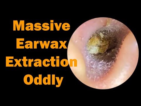 Massive Earwax Extraction Oddly Satisfying Video