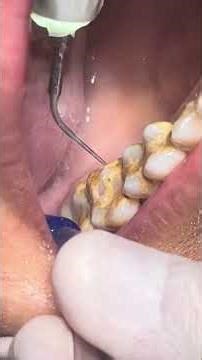 Cleaning Scaling teeth from tartar and calculus #shorts #satisfying #dental #teeth #tooth #scaling