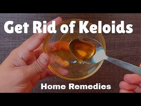 How to Get Rid of Keloids | Natural Home Remedies to Remove Keloids
