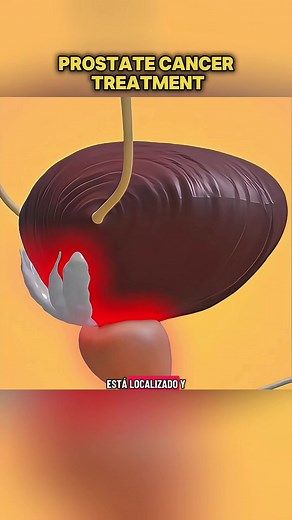 Understanding Prostate Cancer Treatment with 3-D Animation