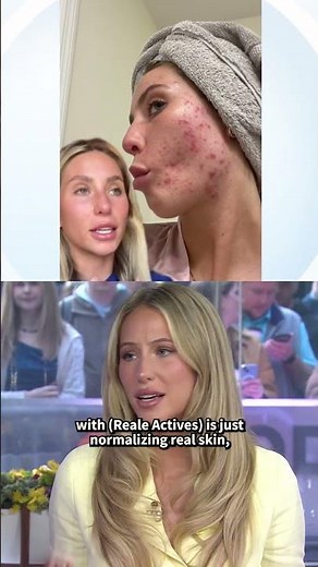 Alix Earle on Showing Acne on Social Media, Not Retouching Reale Actives Photos