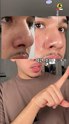 3개월 사용 후 피부가 달라졌다? 마이크로니들 세럼 리얼 후기