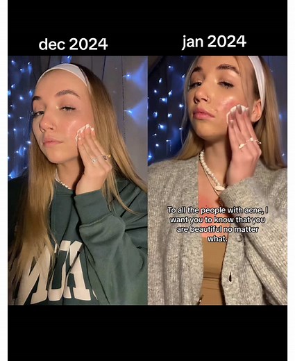 #duet with @DARA🦈 #fyp 😭😭😭 I'm still recovering, but this year has truly brought me a great gift. 💔💔💔 #fyp #acneproneskin #makeup #acnejourney #accutane #roaccutane #acnefighter #acne #selfcare #2024 #cysticacne #acnescars #beforeafter