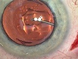 Removal of Silicone Oil from an IOL using the “Hydraulic Squeegee” - Eyetube