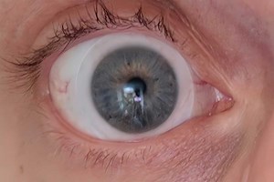 La greffe d'une cornée imprimée en 3D permet à un patient aveugle de recouvrer la vue