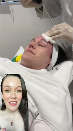 Morpheus 8 Laser Treatment at Beverley Hills Wellness and Aesthetics Clinic