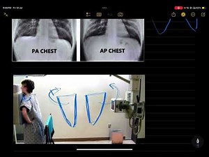 “Chest X-Ray Views: AP vs PA – Easy Tricks to Identify!”