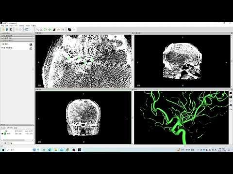 이미지(DCM, DICOM, IMA)를 STL 파일로 변환하는 방법