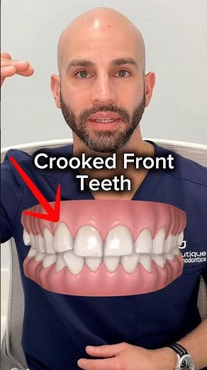 Crooked front teeth and how Invisalign works (at our adult-only, Invisalign-only practice)