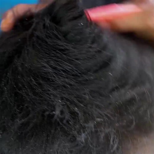 Quick And Safe Scalp Big Flakes !! - Every Day Scratching Dandruff Removal #220 #ticks #removetick #Dandruff #dandrufftreatment #dandruffremoval | Help remove ticks