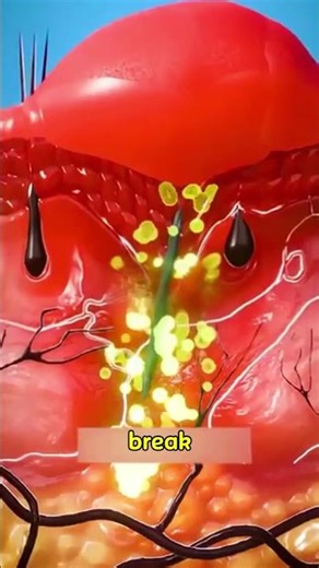 If you ever get a splinter... do this