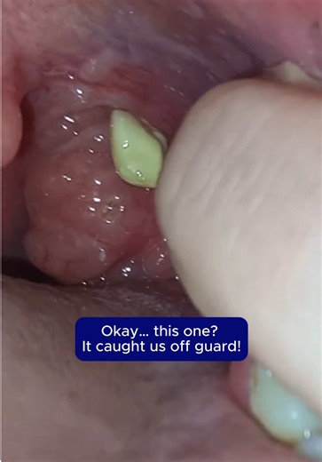 How to Remove Tonsil Stones Effectively