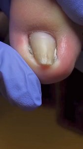 2M views · 4.3K reactions | How to cut ingrown How to Repair Nails easy | Richard | Facebook