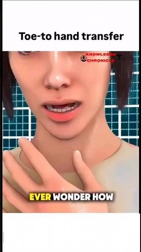 Toe-to-Hand Reconstruction: The Miracle Surgery That Restores Lost Finger Function #shorts #trending