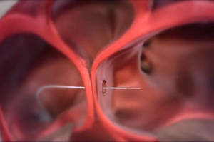 Heart failure: what is atrial flow regulator? | Emergency Live