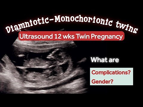 12 Weeks Twin Pregnancy Ultrasound | Monochorionic diamniotic | what can be Complications