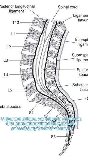 Spinal and Epidural Anaesthesia Technique For OT AND ANAESTHESIA Students #regionalanaesthesia
