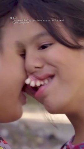 Conjoined twins plan to separate