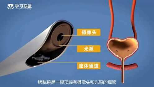 膀胱镜检查（Cystoscopy）-EAU