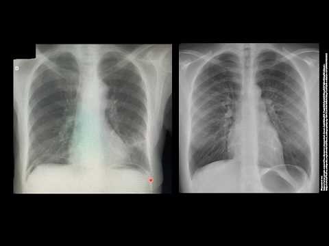 COMO IDENTIFICAR PNEUMOPERITÔNIO NO RX?