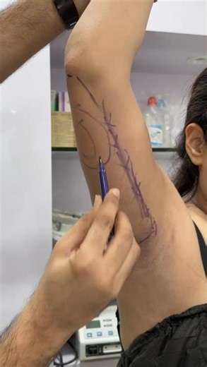 Markings for Arm Fat Removal in Mumbai - Arm Liposuction by Dr. Vishal Patel