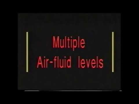 5.3. Intestinal Obstruction (Multiple Air-fluid levels) - Abdomen X-rays