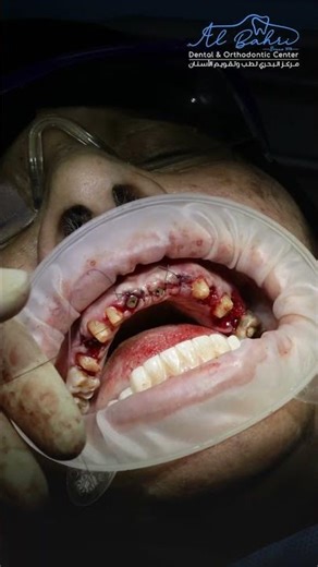 Full Arch Guided Dental Implants Made Easy | Digital Workflow for All-on-X Precision