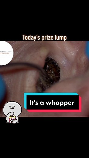 Huge Earwax Removal - Satisfying Video