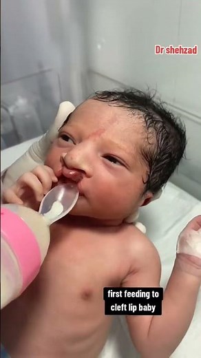 Feeding a Baby with Cleft Lip | Practical Tips for Parents & Caregivers