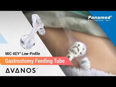 Avanos® Mic-key Low Profile Gastrostomy Feeding Tube