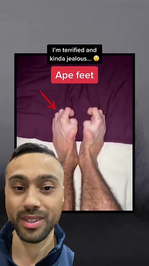 1 in 13 people have this so called ape like feet called mid tarsel break. #strange #weird #facts #medical #podiatry #thegoodfootdoctor
